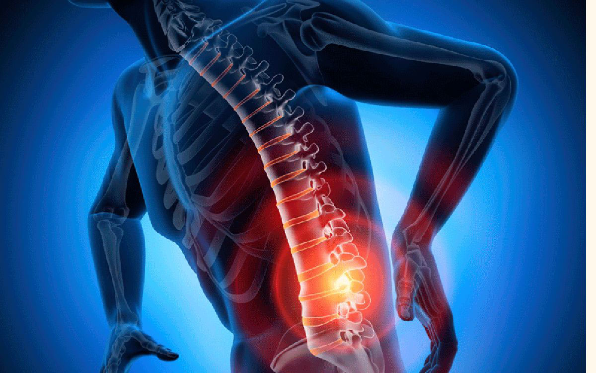 ژن های مرتبط با کمردرد مزمن شناسایی شدند