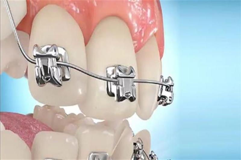بهبود شکنندگی براکت های سرامیکی به کمک محققان ایرانی