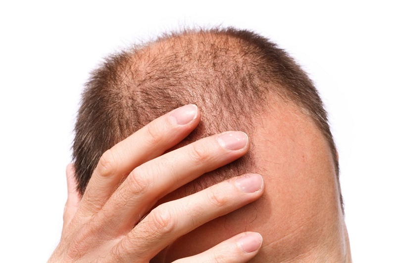 ساخت ابزار پوشیدنی برای رشد مجدد مو