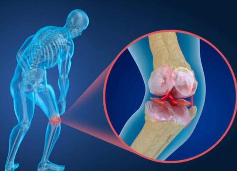 پوکی استخوان، قابل پیشگیری و درمان