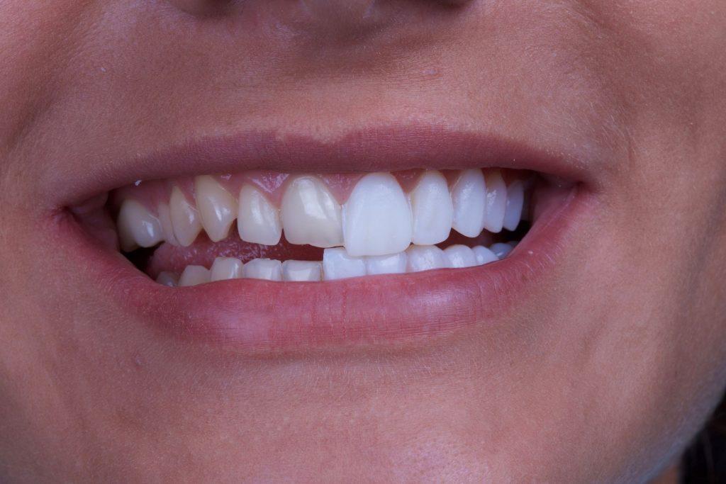 لمینت دندان چیست؟