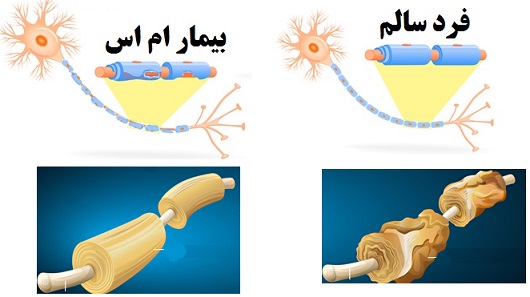 با بیماری ام اس بیشتر آشنا شوید